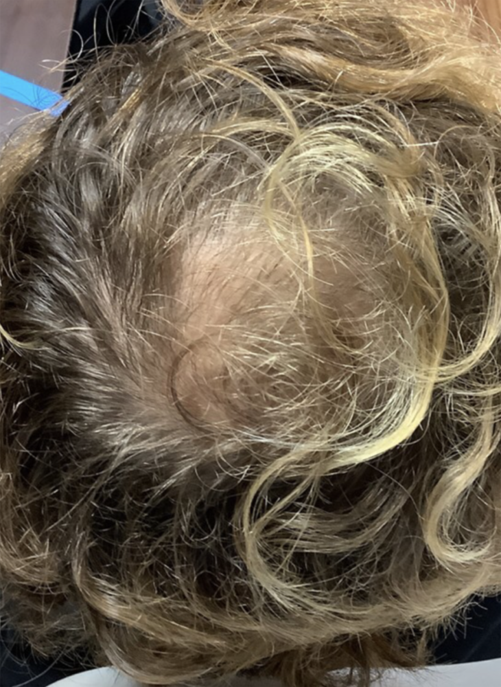 PRP Hair Regrowth Before & After Image