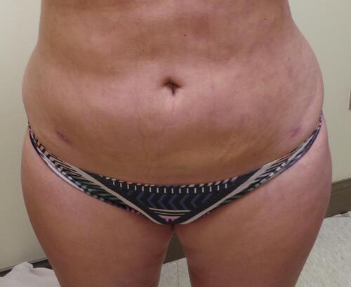 SmartLipo Before & After Image