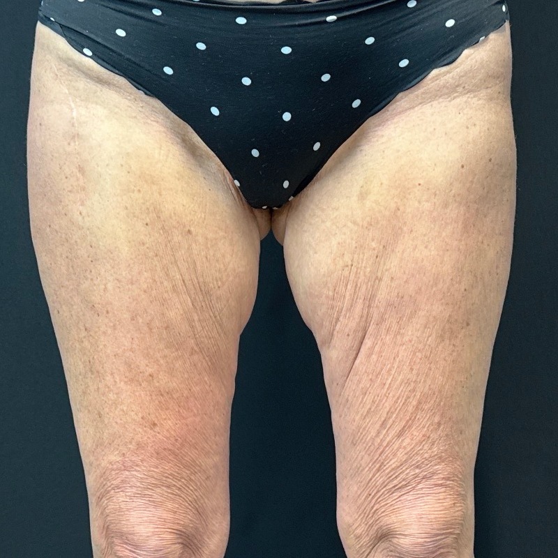 Thigh Lift Before & After Image