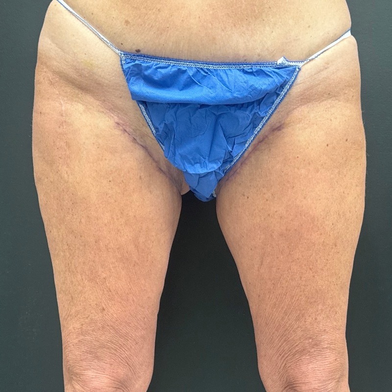 Thigh Lift Before & After Image