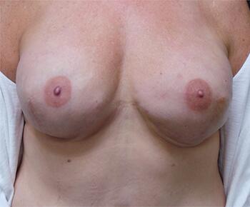 2D and 3D Nipple Tattoo Reconstructions Before & After Image