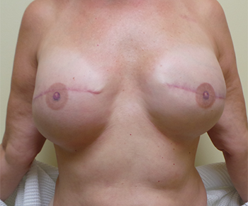 2D and 3D Nipple Tattoo Reconstructions Before & After Image