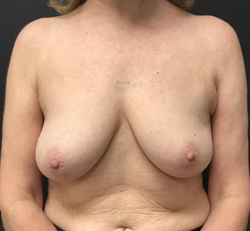 Breast Augmentation Lift Before & After Image