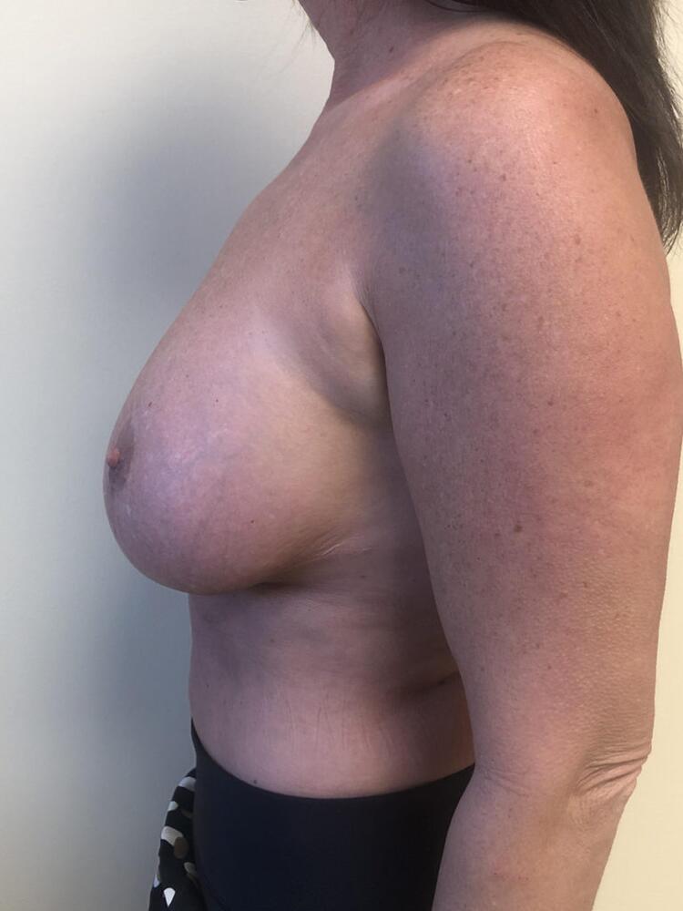 Breast Augmentation Lift Before & After Image