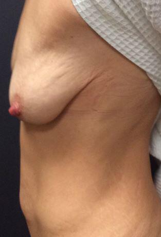 Breast Augmentation Lift Before & After Image