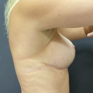 Breast Augmentation Lift Before & After Image