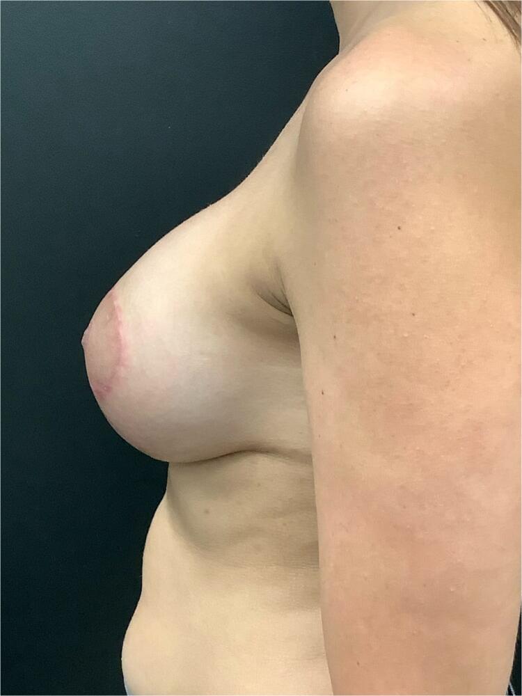 Breast Augmentation Lift Before & After Image