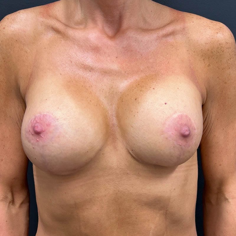 Breast Augmentation Lift Before & After Image
