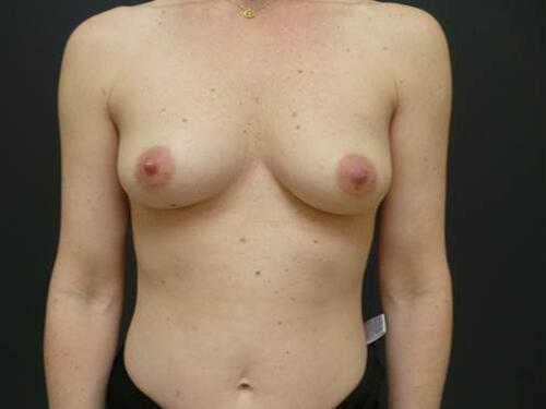 Breast Augmentation Before & After Image