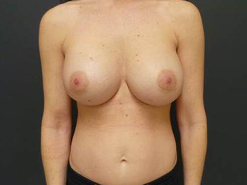 Breast Augmentation Before & After Image