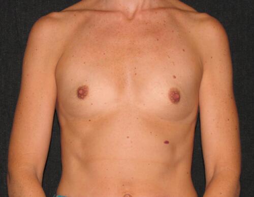 Breast Augmentation Before & After Image