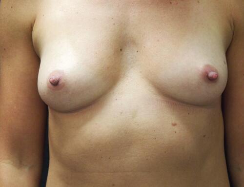 Breast Augmentation Before & After Image