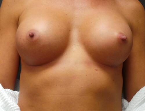 Breast Augmentation Before & After Image