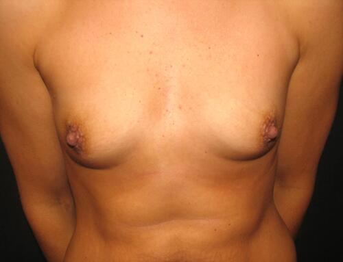 Breast Augmentation Before & After Image