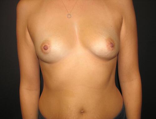 Breast Augmentation Before & After Image