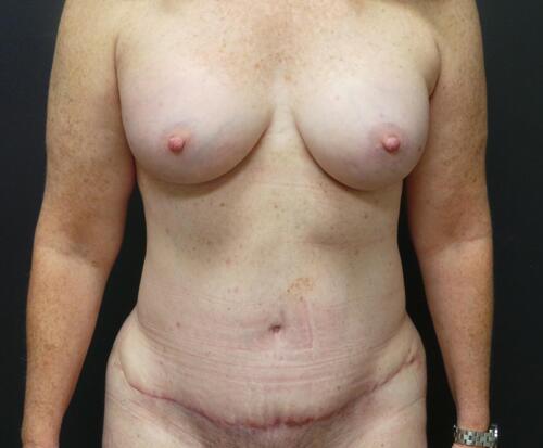 Breast Augmentation Before & After Image