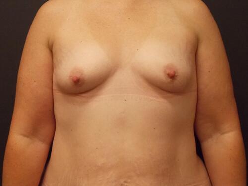 Breast Augmentation Before & After Image