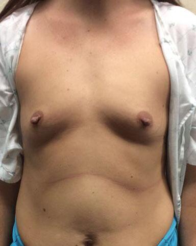 Breast Augmentation Before & After Image