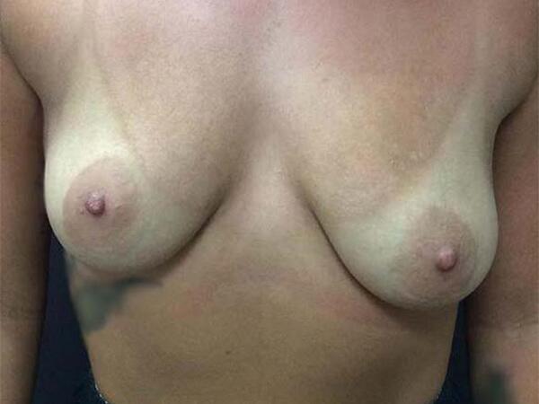 Breast Augmentation Before & After Image