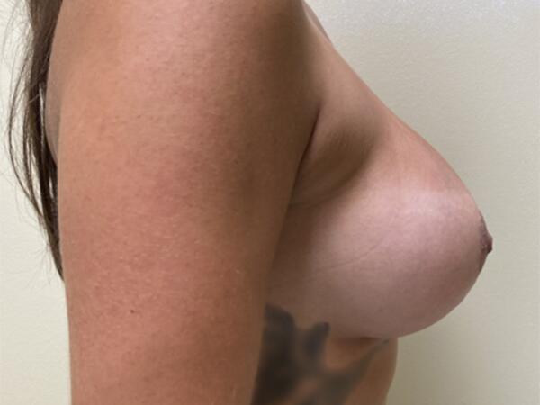 Breast Augmentation Before & After Image