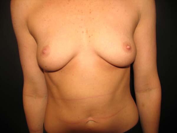 Breast Augmentation Before & After Image