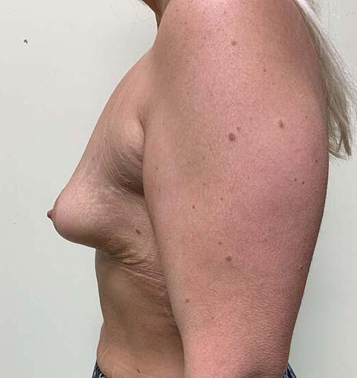 Breast Augmentation Before & After Image