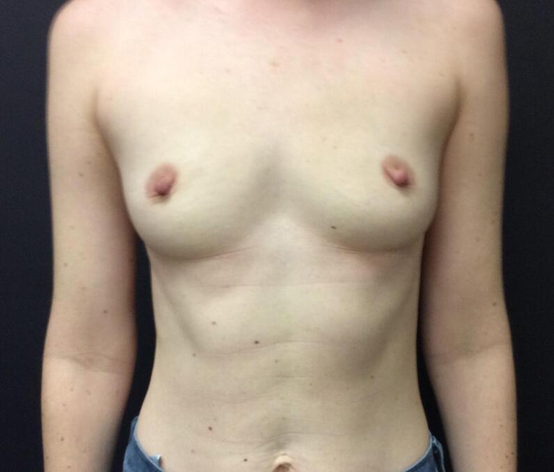 Breast Augmentation Before & After Image