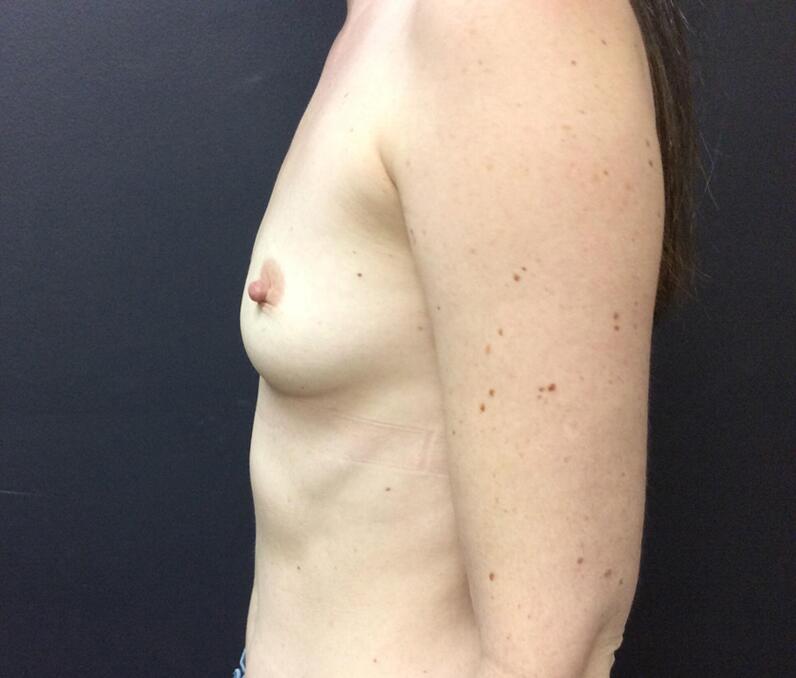 Breast Augmentation Before & After Image