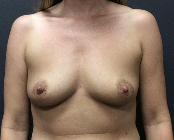 Breast Augmentation Before & After Image