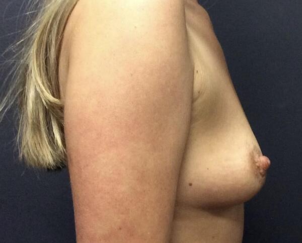 Breast Augmentation Before & After Image