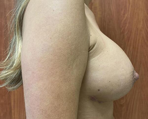 Breast Augmentation Before & After Image