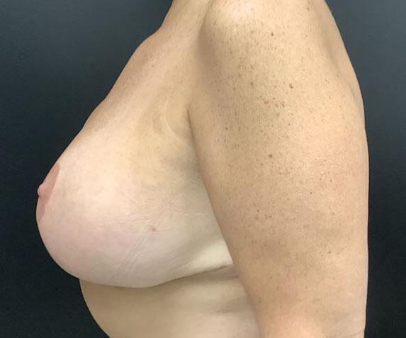 Breast Augmentation Before & After Image