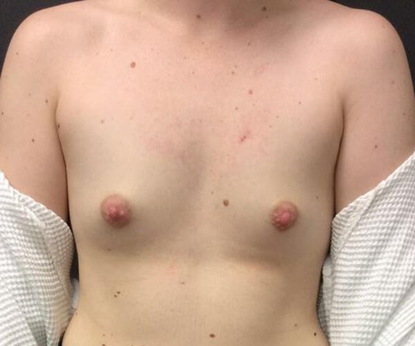 Breast Augmentation Before & After Image