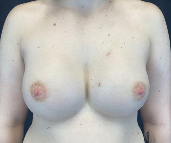 Breast Augmentation Before & After Image