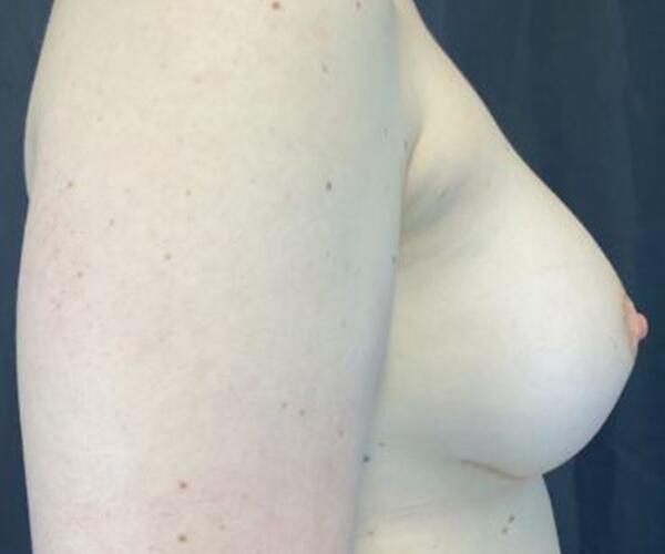 Breast Augmentation Before & After Image