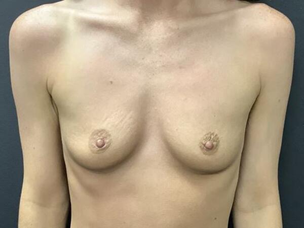 Breast Augmentation Before & After Image