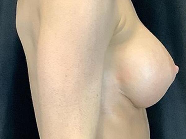 Breast Augmentation Before & After Image