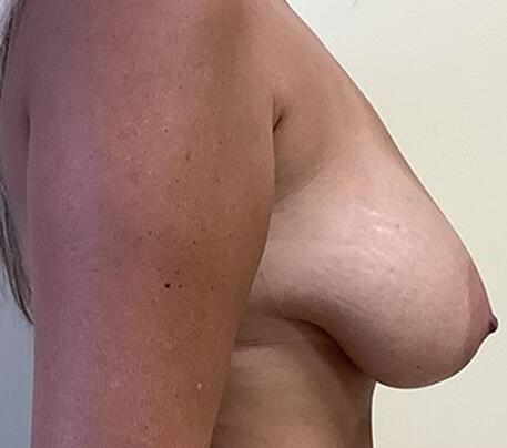 Breast Augmentation Before & After Image