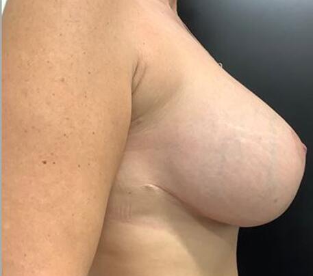 Breast Augmentation Before & After Image