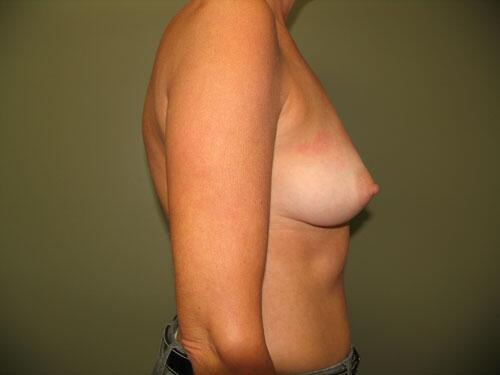 Breast Augmentation Before & After Image