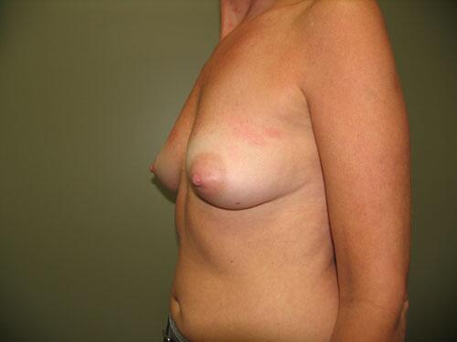 Breast Augmentation Before & After Image