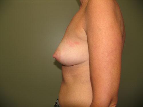 Breast Augmentation Before & After Image