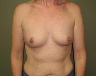 Breast Augmentation Before & After Image