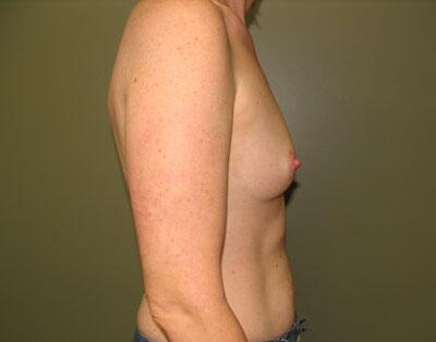 Breast Augmentation Before & After Image