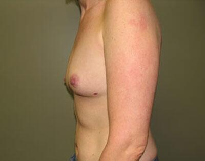 Breast Augmentation Before & After Image