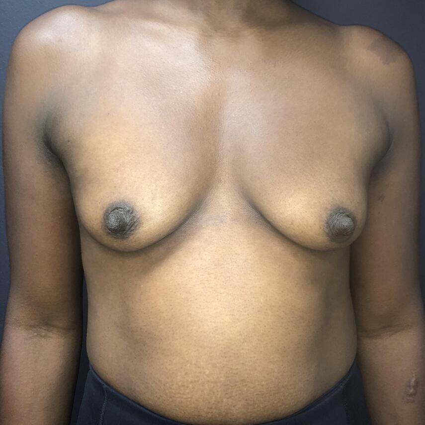 Breast Augmentation Before & After Image