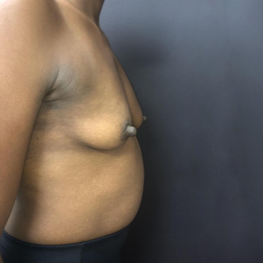 Breast Augmentation Before & After Image