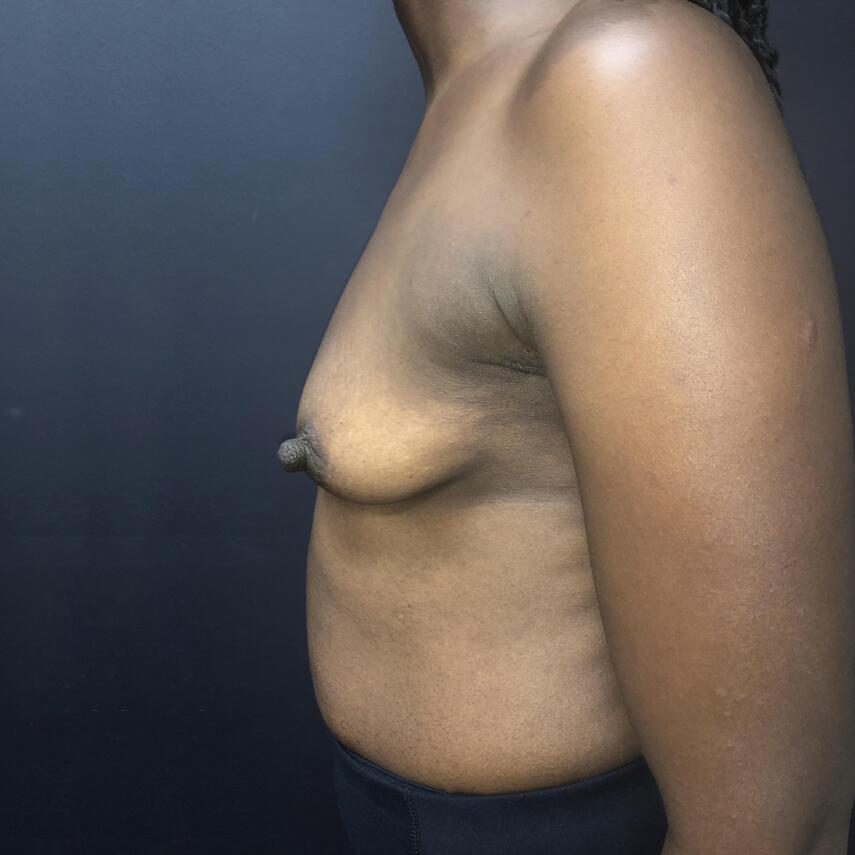 Breast Augmentation Before & After Image