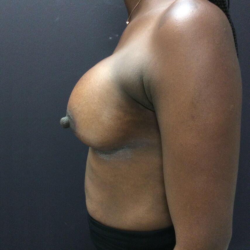 Breast Augmentation Before & After Image