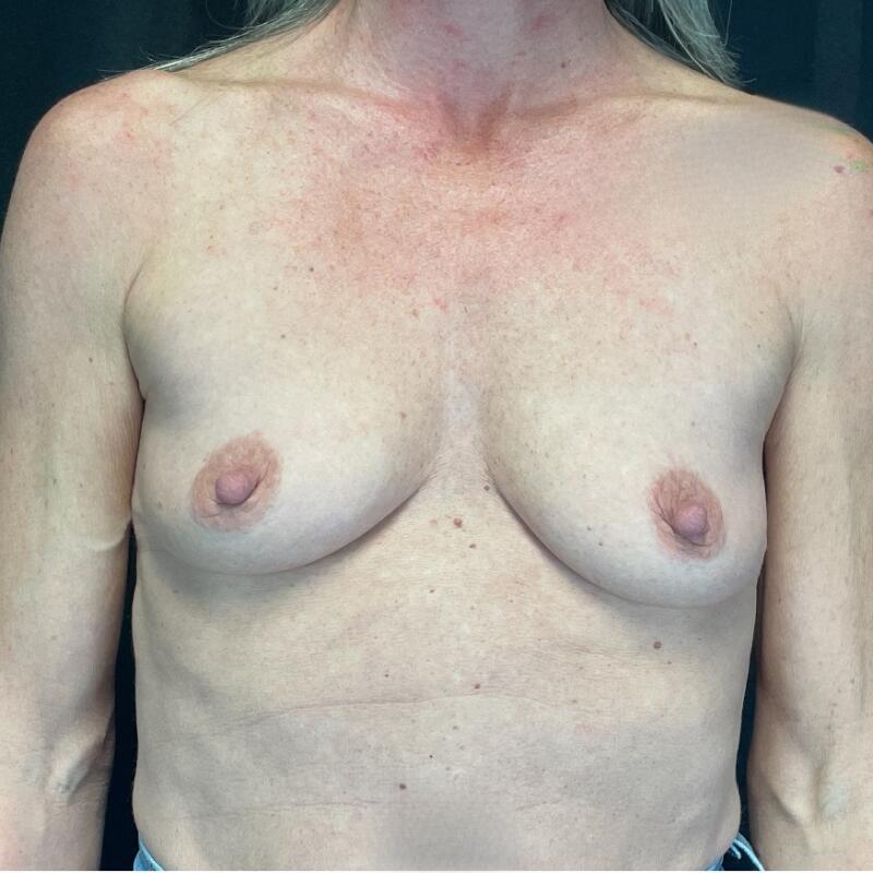 Breast Augmentation Before & After Image